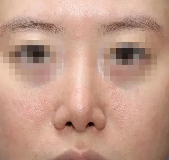 코끝 날개이식 임상 사진