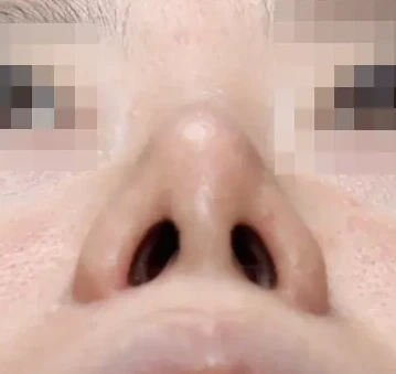 코끝 날개이식 임상 사진