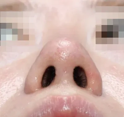 코끝 날개이식 임상 사진