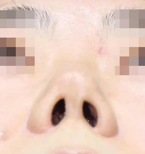 코끝 날개이식 임상 사진