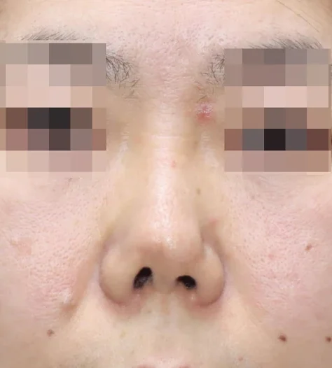 코끝 날개이식 임상 사진