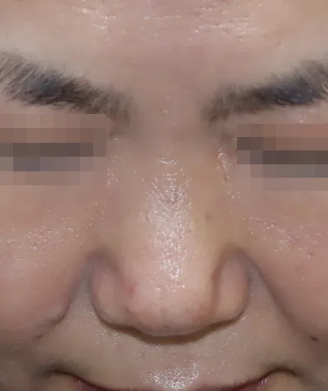 코끝 날개이식 임상 사진