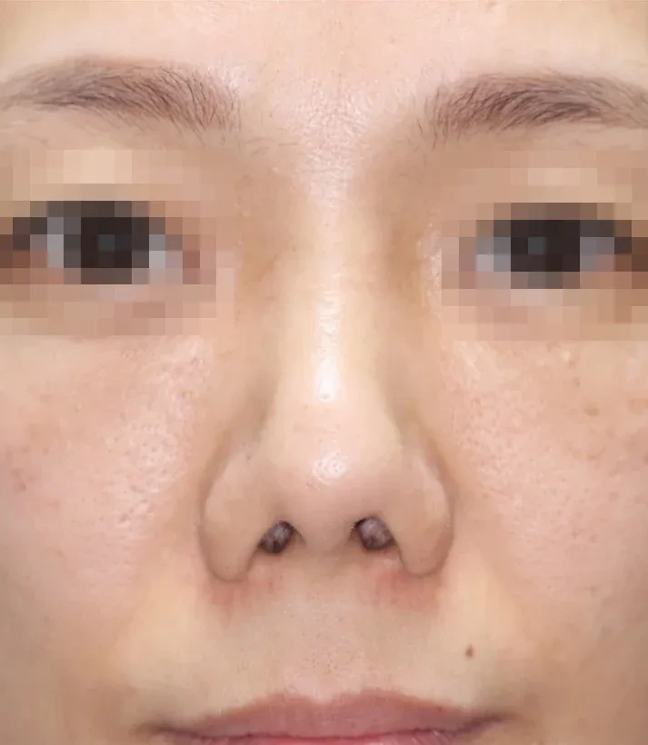 코끝 날개이식 임상 사진