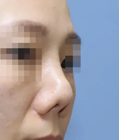 코끝 날개이식 임상 사진