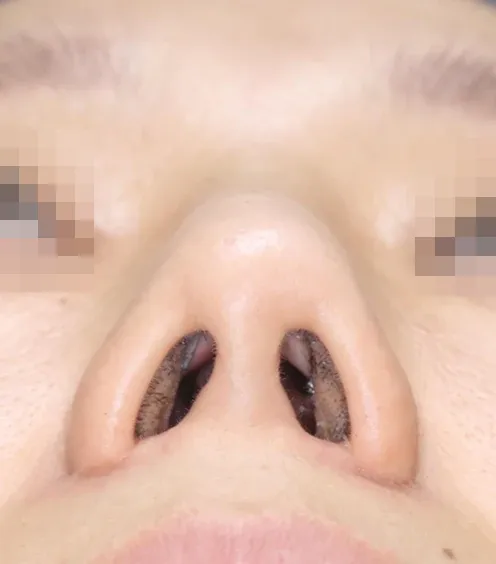 코끝 날개이식 임상 사진