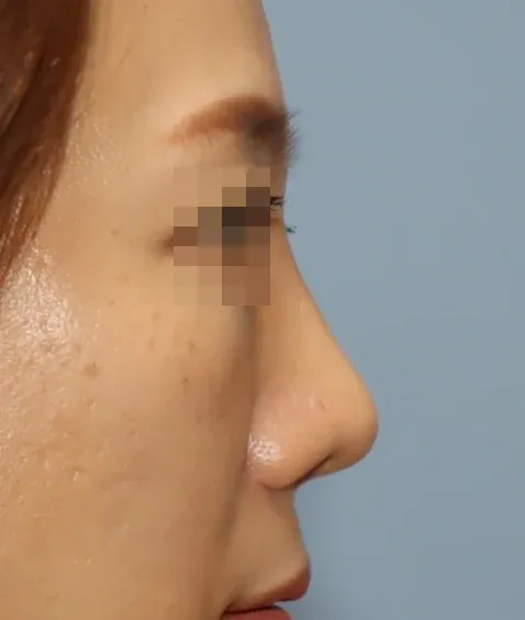 코끝 날개이식 임상 사진