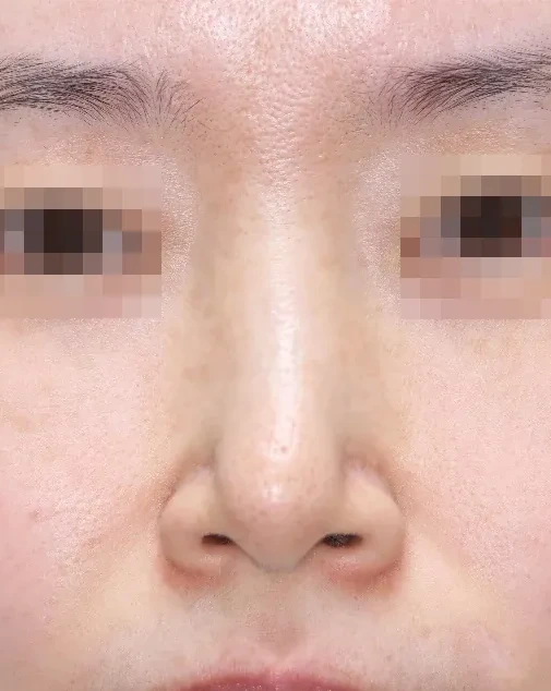 코끝 날개이식 임상 사진