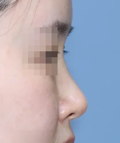 코끝 날개이식 임상 사진