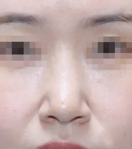 코끝 날개이식 임상 사진