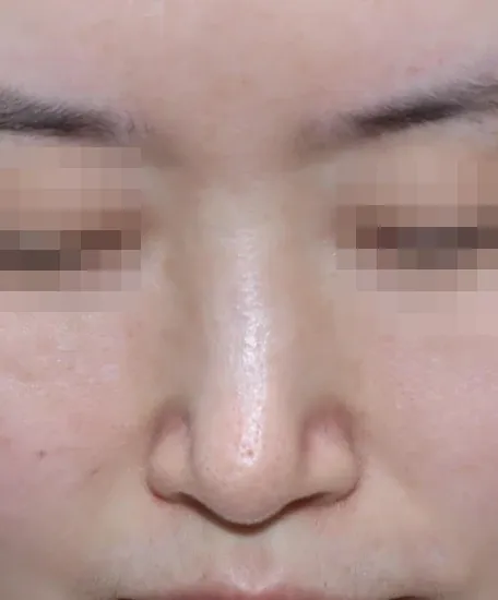 코끝 날개이식 임상 사진