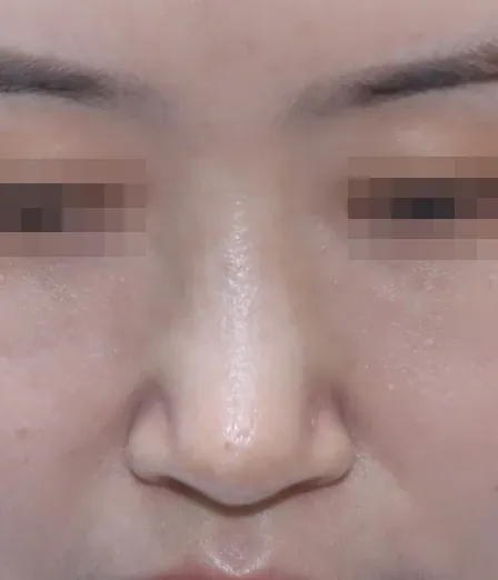 코끝 날개이식 임상 사진