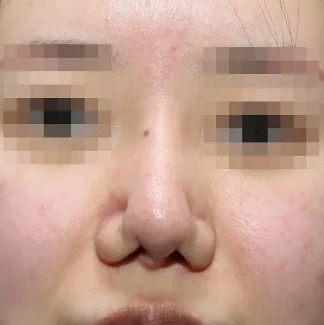 코끝 날개이식 임상 사진