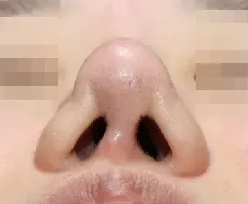 코끝 날개이식 임상 사진