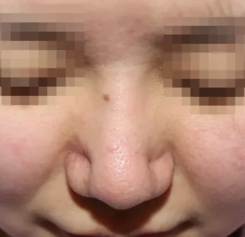 코끝 날개이식 임상 사진