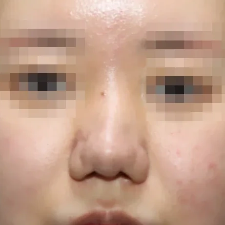 코끝 날개이식 임상 사진