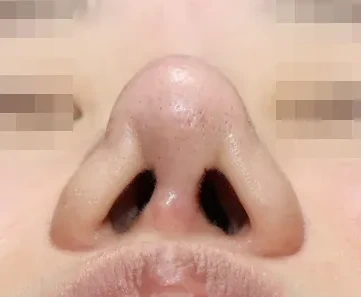 코끝 날개이식 임상 사진