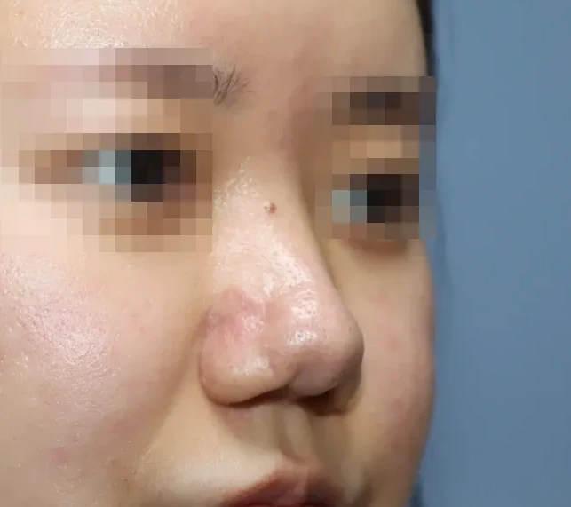 코끝 날개이식 임상 사진