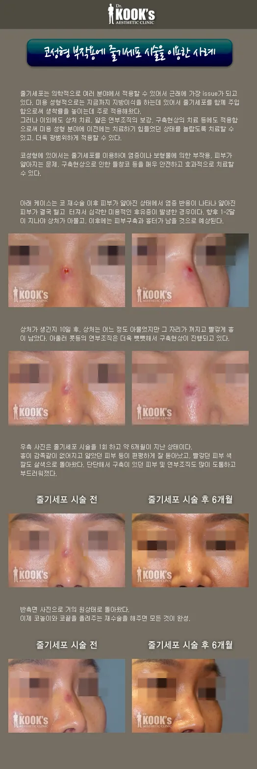 코성형 부작용에 줄기세포 시술을 이용한 사례