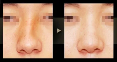 코성형, 휜 코와 비중격 만곡증은 동시에 해결해야 이미지