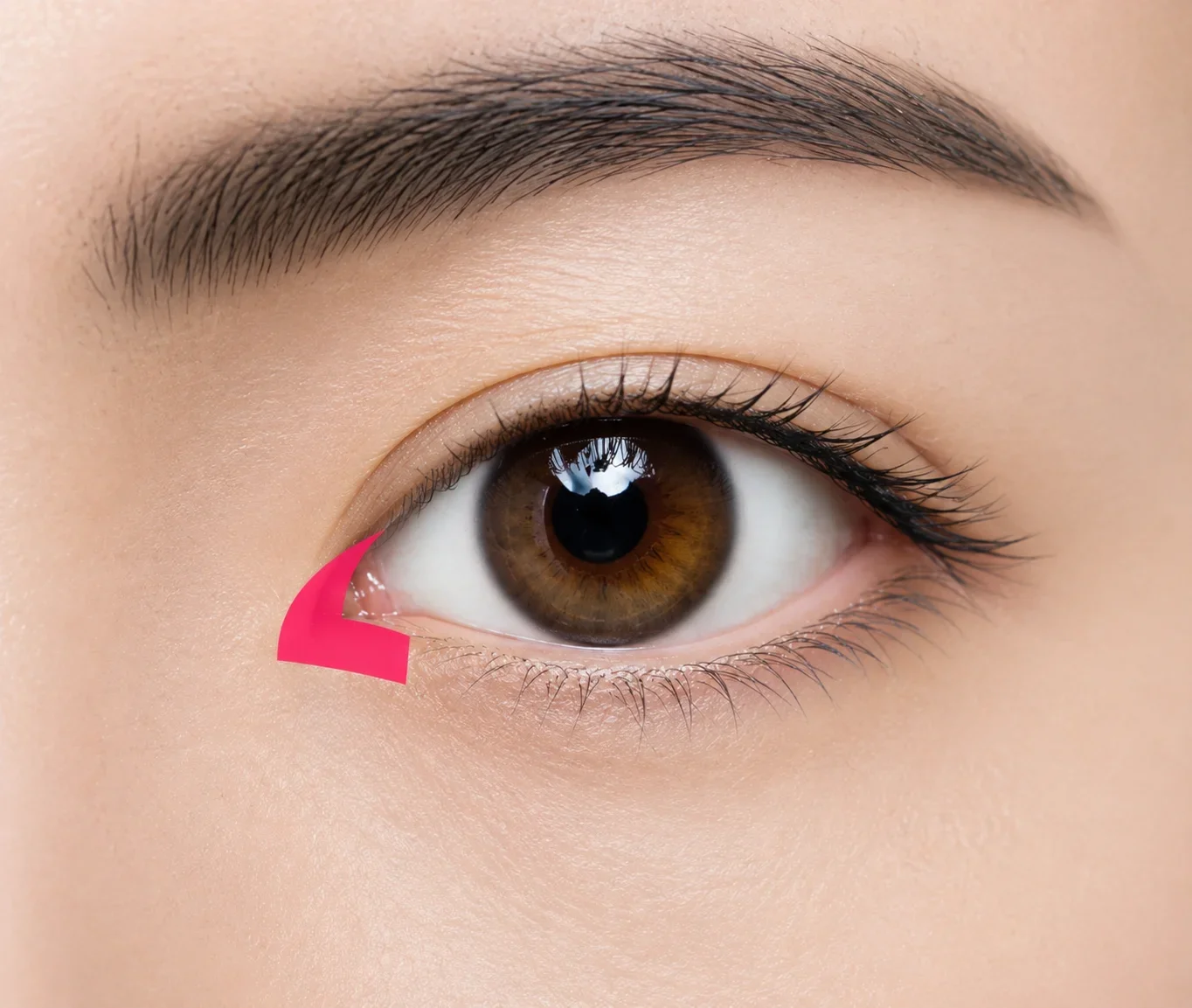 앞트임 SUTURE 안내 이미지