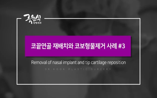 코끝연골 재배치와 코보형물제거 사례 #3