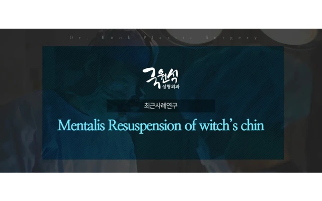 Mentalis Resuspension of witch’s chin, ptotic chin