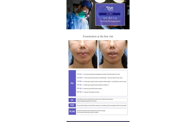 Mentalis Resuspension/ptotic chin/chin ptosis